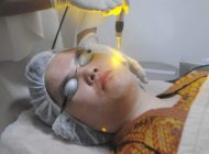 Yellow Laser Therapy