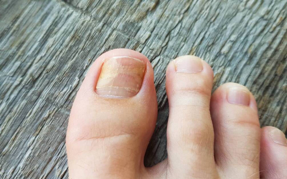 toenail fungus pictures before and after